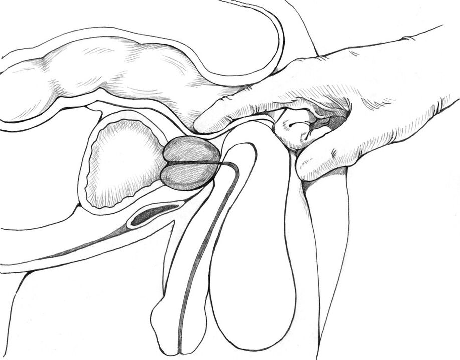 Prostate massage belongs to the complex of methods for treating prostatitis